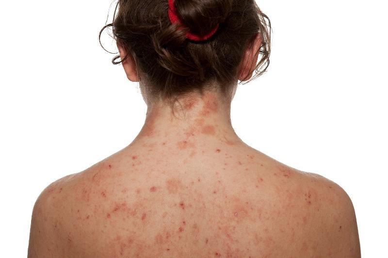 Dermatite atópica: especialista dá dicas de cuidados para portadores da doença