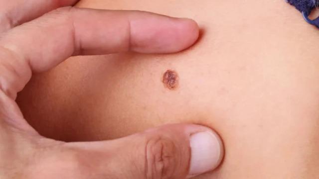 Dezembro Laranja: profissionais do 16º Centro de Saúde em Salvador reforçam cuidados diante do aumento de casos de câncer de pele